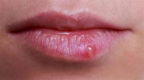 嘴巴周围长痘痘是什么原因 嘴周围疯狂长痘的原因 - 知乎
