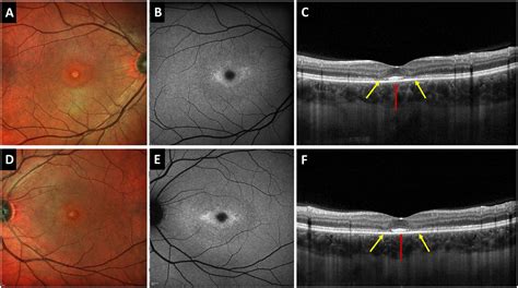 Foveal photoreceptor disruption in ocular diseases: An optical coherence tomography-based ...