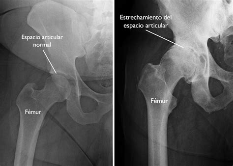 Artrosis de cadera (Hip Osteoarthritis) - OrthoInfo - AAOS