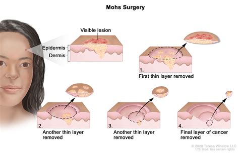 Basal Cell Carcinoma Early Stages Face