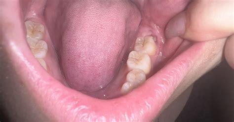 Does this look like my wisdom tooth is growing in normally? It’s only this one that has started ...