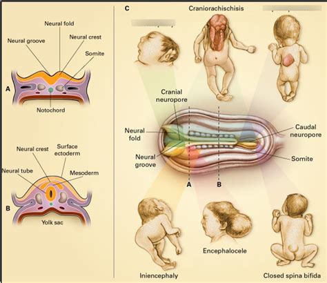 Image result for Neural Tube Defects Causes