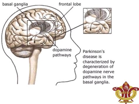 Parkinson's disease & pathophysiology | PPTX - mechanism of parkinson's disease