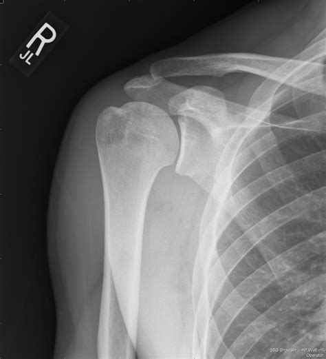 Xray Shoulder Normal