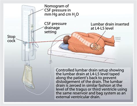 How To Measure Intracranial Pressure Lumbar Puncture at Beverly ...