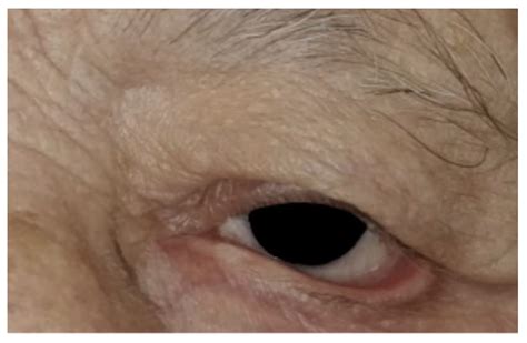 Ectropion Repair Techniques and the Role of Adjunctive Superotemporal ...