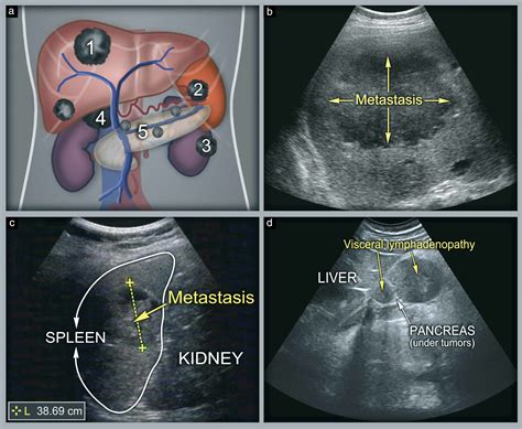 Ultrasound scanning of the pelvis and abdomen for staging of ...