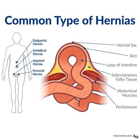 Spigelian Hernia Symptoms