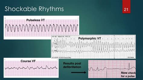 What Is A Shockable Rhythm at Aiden Ligar blog