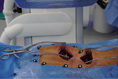 Minimally Invasive AIS SurgeryDr. Alejandro Peiró García - Neo Medical