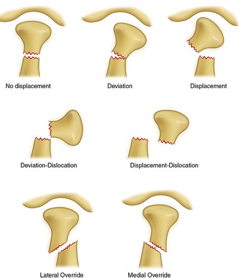 Mandible Condylar Process