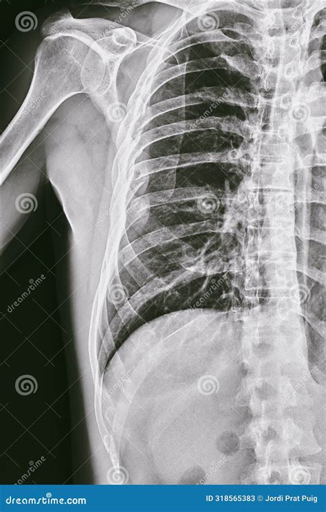 X Ray Broken Ribs
