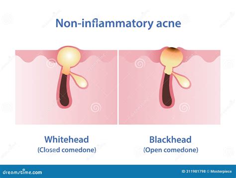 What Is The Difference Between A Blackhead And A Pimple at Benjamin Downie blog