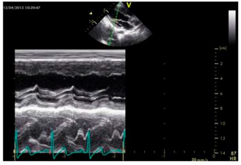 The Value of SIRT1/FOXO1 Signaling Pathway in Early Detection of ...