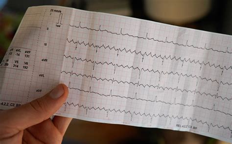 AFib Heart Condition 的图像结果