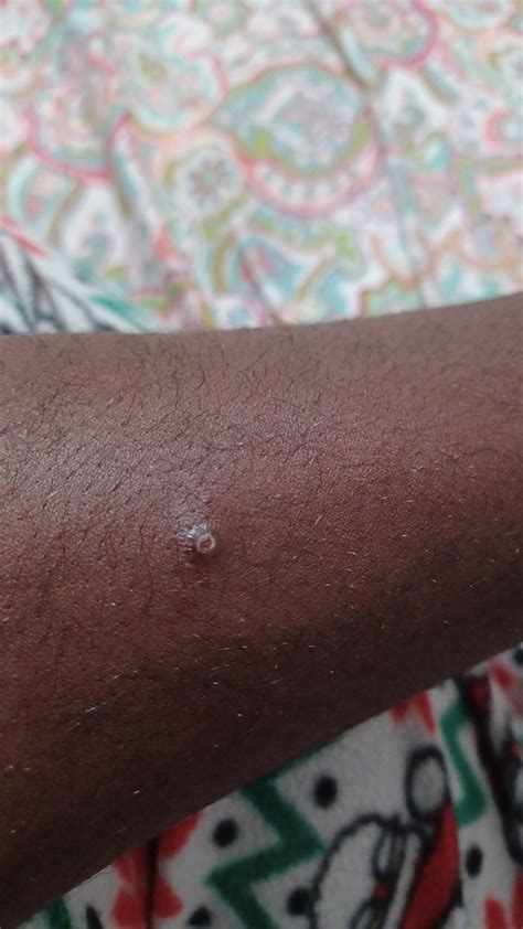 Pimple on my nipple? (please help) : r/pimplecommunity