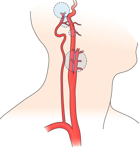 Carotid Body Tumors - Clinical Tree