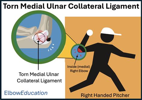 Torn Ulnar Collateral Ligament - Elbow Education