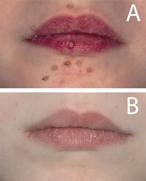 Warts On Lips Removal | Lipstutorial.org