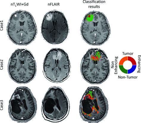 Classification of High-Grade Glioma into Tumor and Nontumor Components Using Support Vector ...