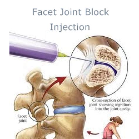 Accurate Education – Facet Joint Injections and Nerve Procedures