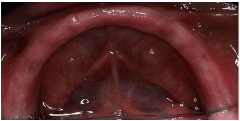 Optimizing Digital Impressions in Edentulous Patients Through Reference ...