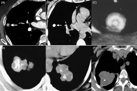 Popcorn Calcification Of Lung at Audrey Tyler blog