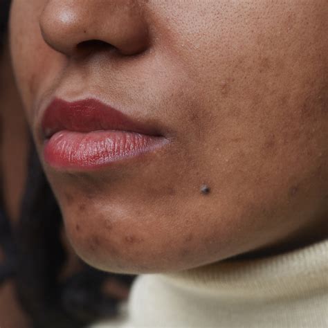How to Get Rid of Blackheads: Best Ways to Remove Blackheads ...