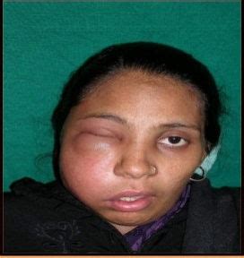 Head & Neck Space Infection