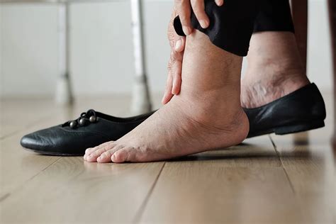 Water Retention: Causes and Treatment