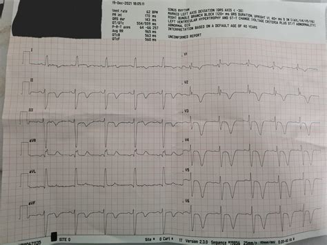 Cerebral T waves: Hugh inverted T waves with a QTc prolongation : r/EKGs