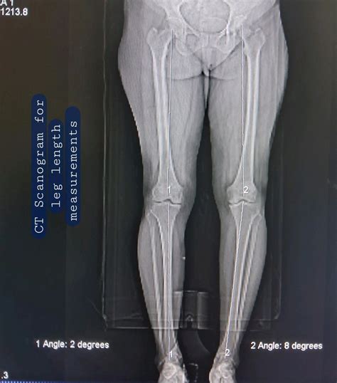 Scanogram Leg Length