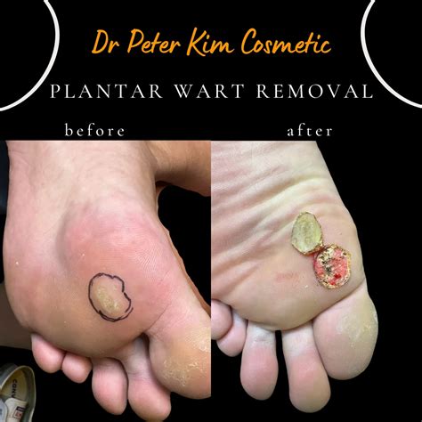 Plantar Wart Removed Plantar Wart Treatment New Horizons Foot And