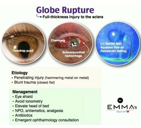 Ruptured Globe