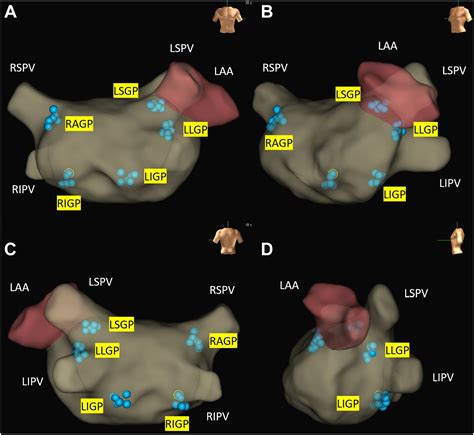 Endocardial autonomic denervation of the left atrium to treat recurrent micturition syncope ...