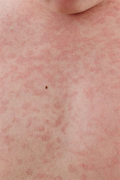 Bildergebnis für rubella symptoms