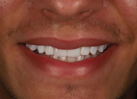 Gum Abscess Popped? Thinking of Popping It Yourself?