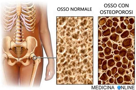Osteoporosi: cause, diagnosi, cure, osteopenia, valori Z-score e T-score | MEDICINA ONLINE