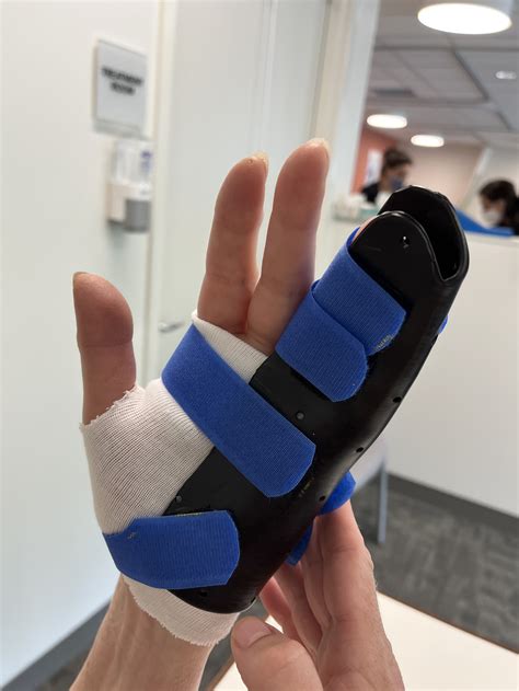 Custom Splint/Orthotic Fabrication — Impact PT & Ergonomic Solutions
