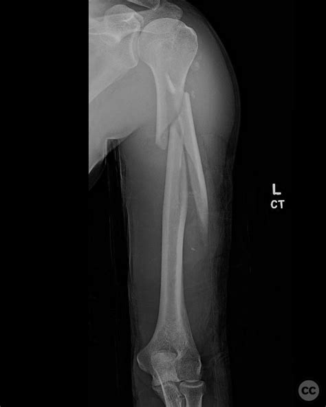 Spiral Fracture In Humerus at Bryan Hanes blog