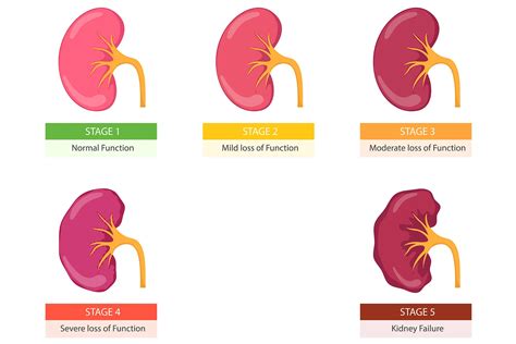 What Are The Four Types Of Kidney Disease - Infoupdate.org
