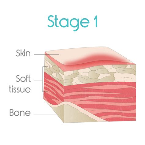 Bed Sores Treatment [Ultimate Guide] — Vive Health