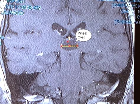 Gray Matters To Me - Symptomatic Pineal Gland Cysts Do Exist!: May 2015