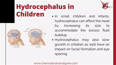 Hydrocephalus in adults and children | PDF