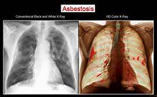 lung cancer photo all about asbestos asbestos exposure raises cancer rates in lebanon green lung cancer photo all about asbestos asbestos exposure raises cancer rates in lebanon green
