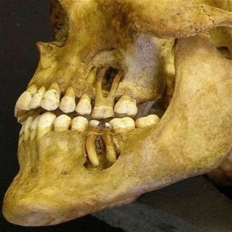 DentalRadar | 🇺🇸Filiform wart on the lip Filiform warts look different ...