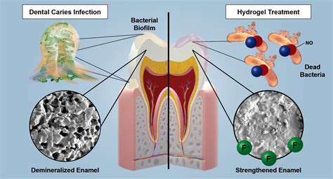 Dental Caries Treatment
