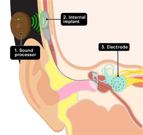 Image result for How Cochlear Implants Sound