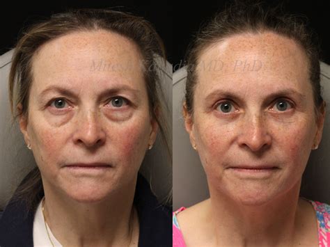 Before and 6 months after upper and lower blepharoplasty surgery with lower lid CO2 laser ...