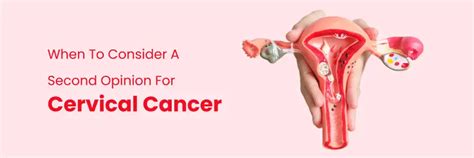 Key Times to Consider a Second Opinion for Cervical Cancer